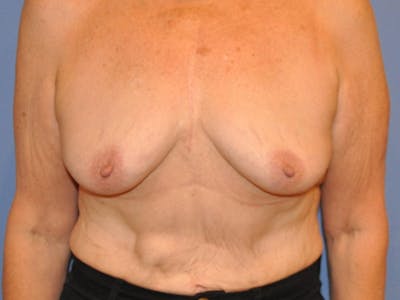 Breast Augmentation Before & After Gallery - Patient 13574640 - Image 1