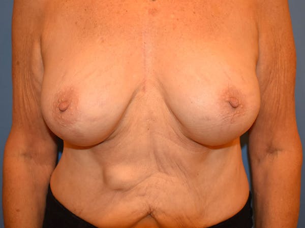 Breast Augmentation Before & After Gallery - Patient 13574640 - Image 2