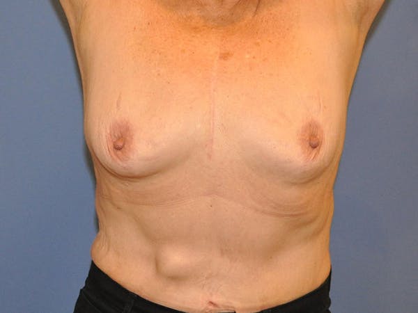 Breast Augmentation Before & After Gallery - Patient 13574640 - Image 3