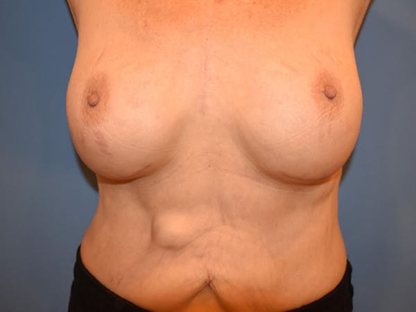 Breast Augmentation Before & After Gallery - Patient 13574640 - Image 4