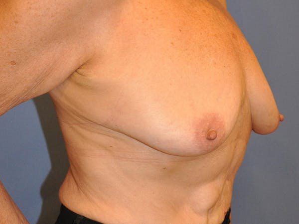 Breast Augmentation Before & After Gallery - Patient 13574640 - Image 5