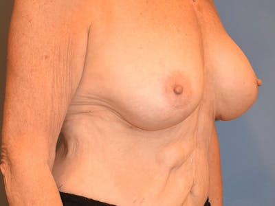 Breast Augmentation Before & After Gallery - Patient 13574640 - Image 6