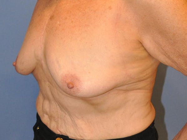 Breast Augmentation Before & After Gallery - Patient 13574640 - Image 7