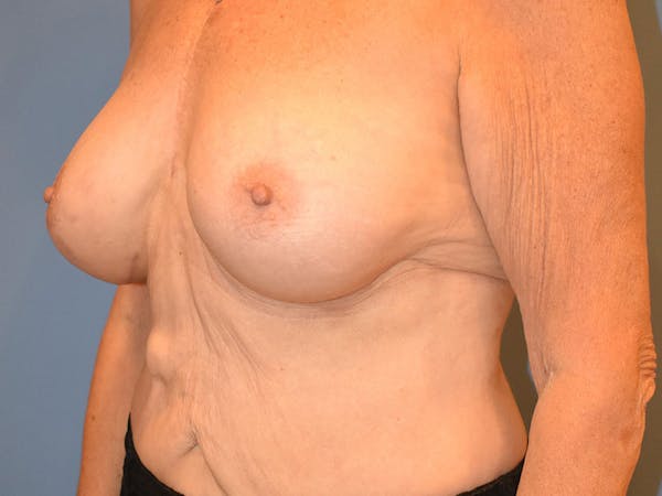 Breast Augmentation Before & After Gallery - Patient 13574640 - Image 8