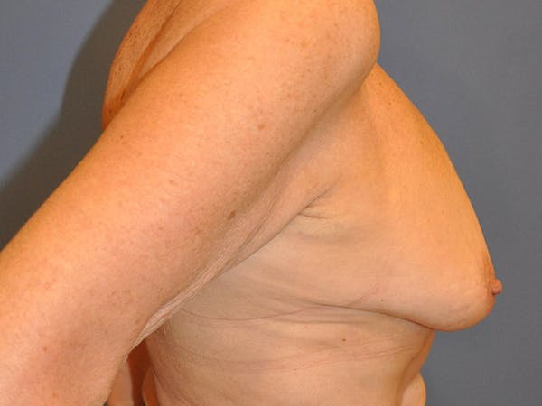 Breast Augmentation Before & After Gallery - Patient 13574640 - Image 9
