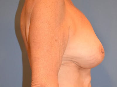 Breast Augmentation Before & After Gallery - Patient 13574640 - Image 10