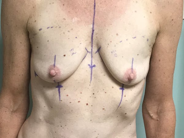 Breast Augmentation Before & After Gallery - Patient 13574652 - Image 1