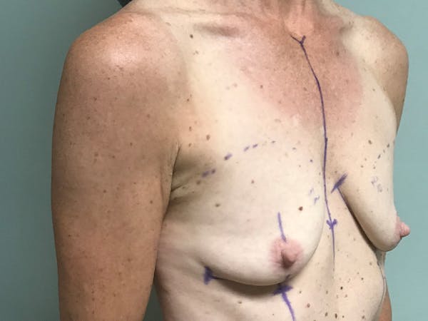 Breast Augmentation Before & After Gallery - Patient 13574652 - Image 3