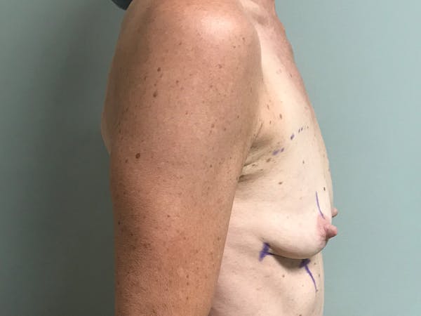 Breast Augmentation Before & After Gallery - Patient 13574652 - Image 5