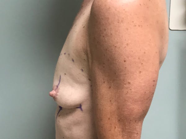 Breast Augmentation Before & After Gallery - Patient 13574652 - Image 7
