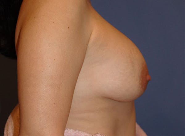 Breast Revision Before & After Gallery - Patient 13574660 - Image 5