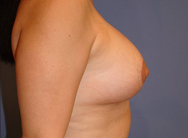 Breast Revision Before & After Gallery - Patient 13574660 - Image 6