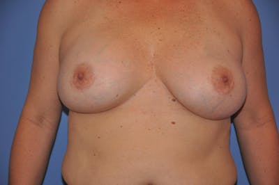 Breast Revision Before & After Gallery - Patient 13574661 - Image 2