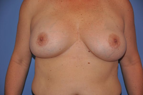 Breast Revision Before & After Gallery - Patient 13574661 - Image 2
