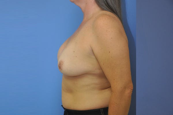 Breast Revision Before & After Gallery - Patient 13574661 - Image 5