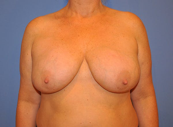 Breast Revision Before & After Gallery - Patient 13574664 - Image 1