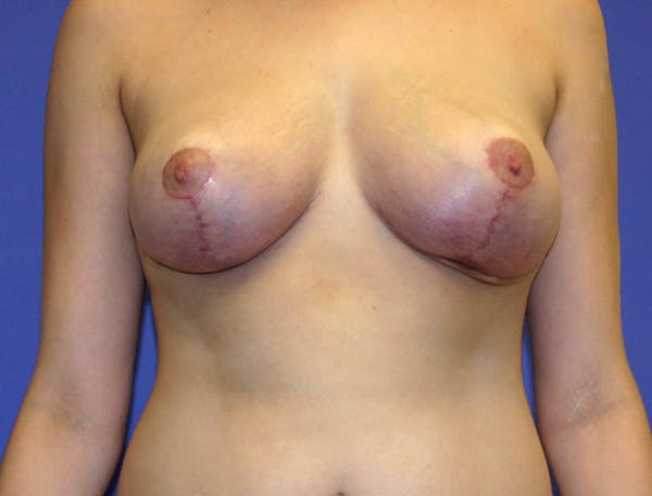 Breast Reduction Before & After Gallery - Patient 13574665 - Image 2