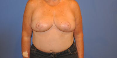 Breast Reduction Before & After Gallery - Patient 13574666 - Image 2