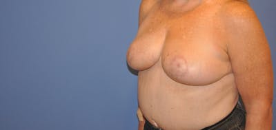 Breast Reduction Before & After Gallery - Patient 13574666 - Image 4