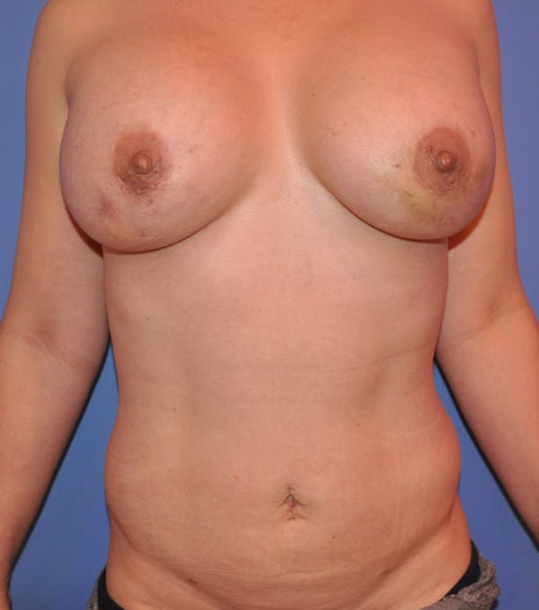 Breast Fat Grafting Before & After Gallery - Patient 13574673 - Image 2