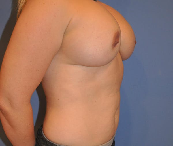 Breast Fat Grafting Before & After Gallery - Patient 13574673 - Image 3