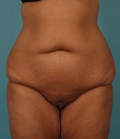 Tummy Tuck (Abdominoplasty) Gallery - Patient 13574686 - Image 1