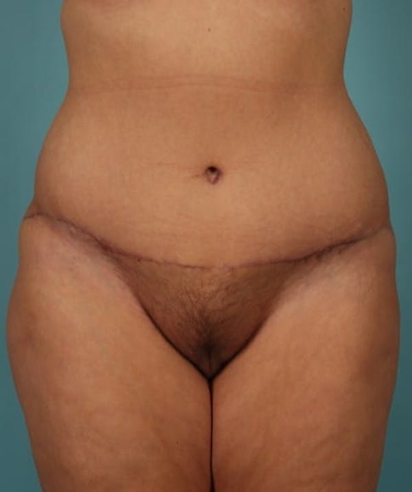 Tummy Tuck (Abdominoplasty) Gallery - Patient 13574686 - Image 2