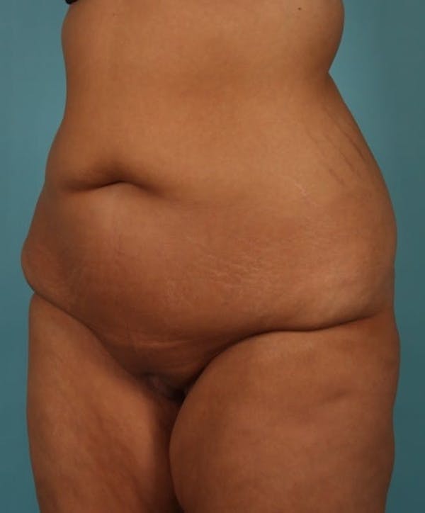 Tummy Tuck (Abdominoplasty) Before & After Gallery - Patient 13574686 - Image 3