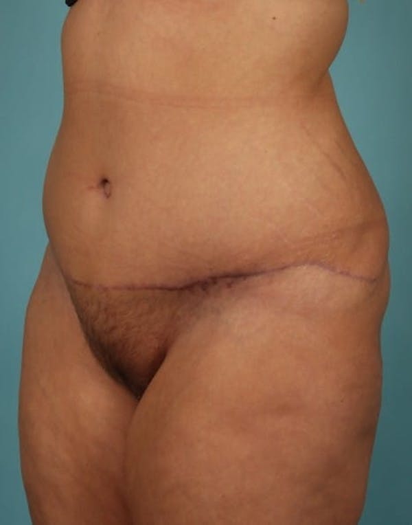 Tummy Tuck (Abdominoplasty) Before & After Gallery - Patient 13574686 - Image 4