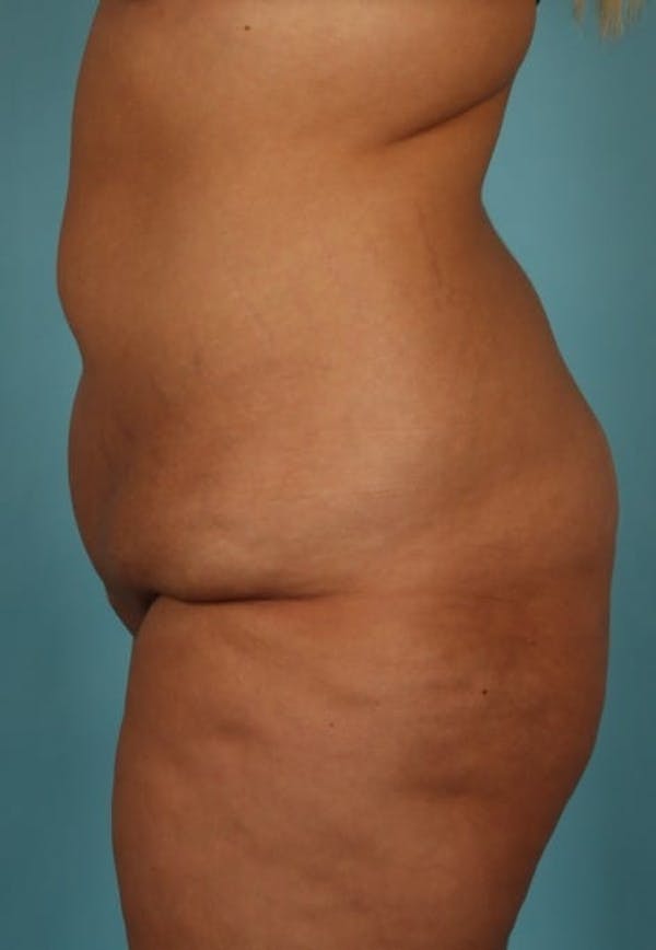Tummy Tuck (Abdominoplasty) Before & After Gallery - Patient 13574686 - Image 5
