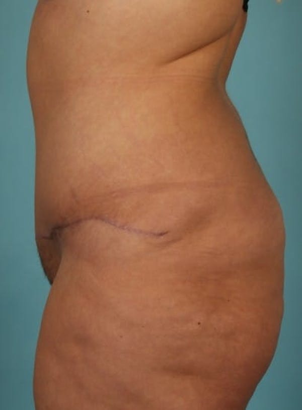 Tummy Tuck (Abdominoplasty) Before & After Gallery - Patient 13574686 - Image 6