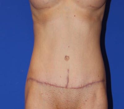 Tummy Tuck (Abdominoplasty) Before & After Gallery - Patient 13574687 - Image 2