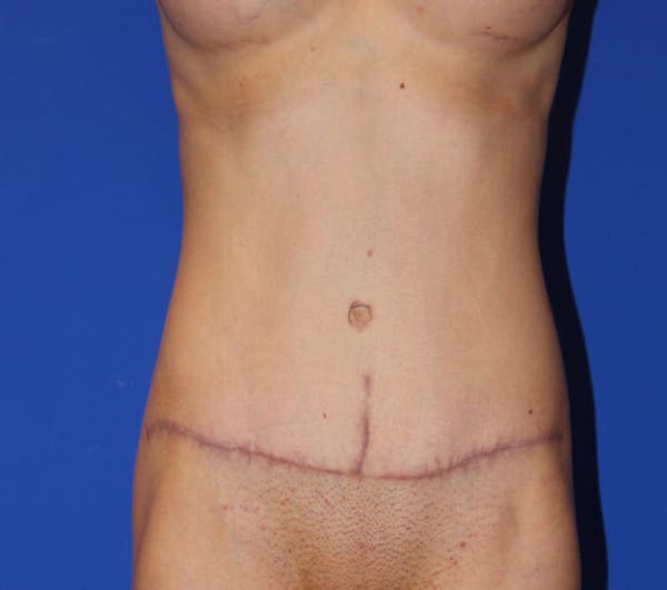Tummy Tuck (Abdominoplasty) Before & After Gallery - Patient 13574687 - Image 2