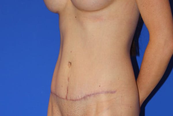 Tummy Tuck (Abdominoplasty) Before & After Gallery - Patient 13574687 - Image 4