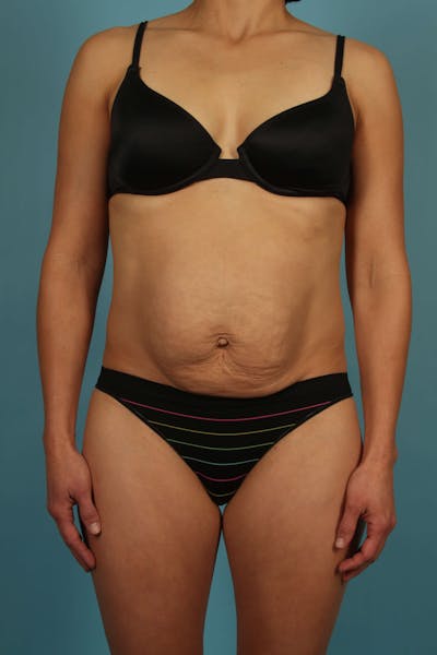 Tummy Tuck (Abdominoplasty) Before & After Gallery - Patient 13574688 - Image 1
