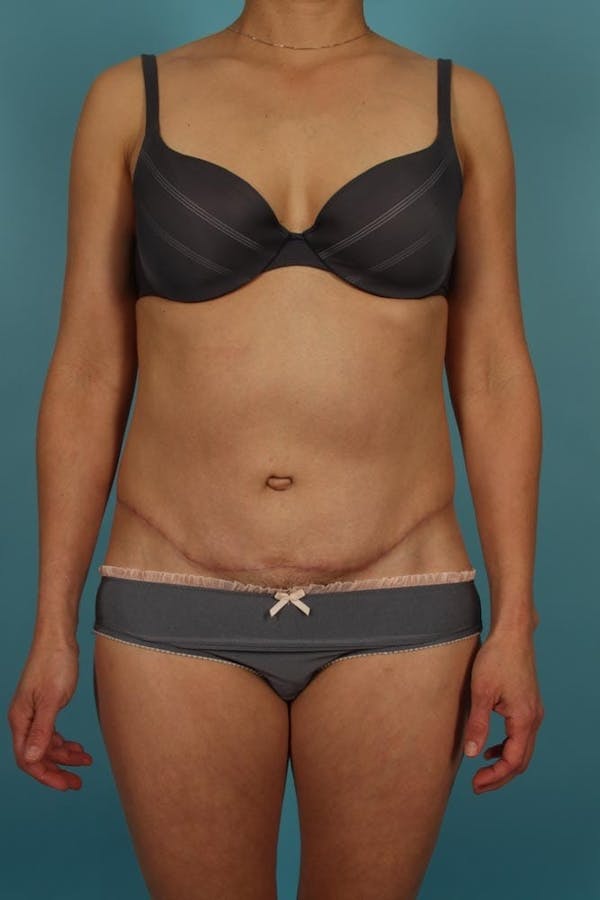 Tummy Tuck (Abdominoplasty) Before & After Gallery - Patient 13574688 - Image 2