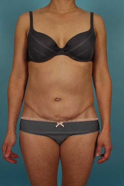 Tummy Tuck (Abdominoplasty) Before & After Gallery - Patient 13574688 - Image 2