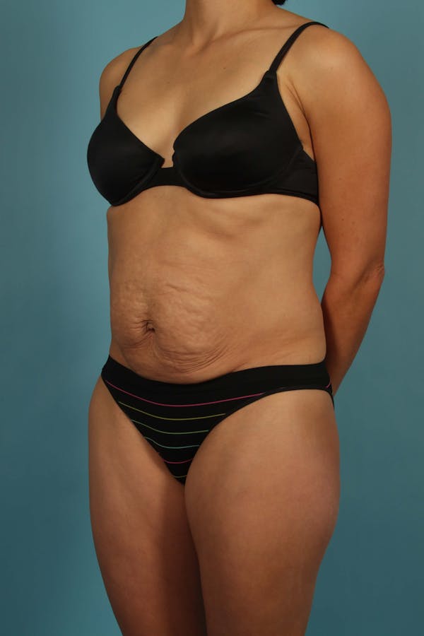 Tummy Tuck (Abdominoplasty) Before & After Gallery - Patient 13574688 - Image 3