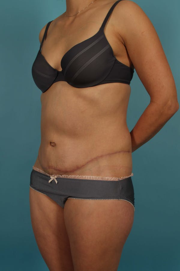 Tummy Tuck (Abdominoplasty) Before & After Gallery - Patient 13574688 - Image 4