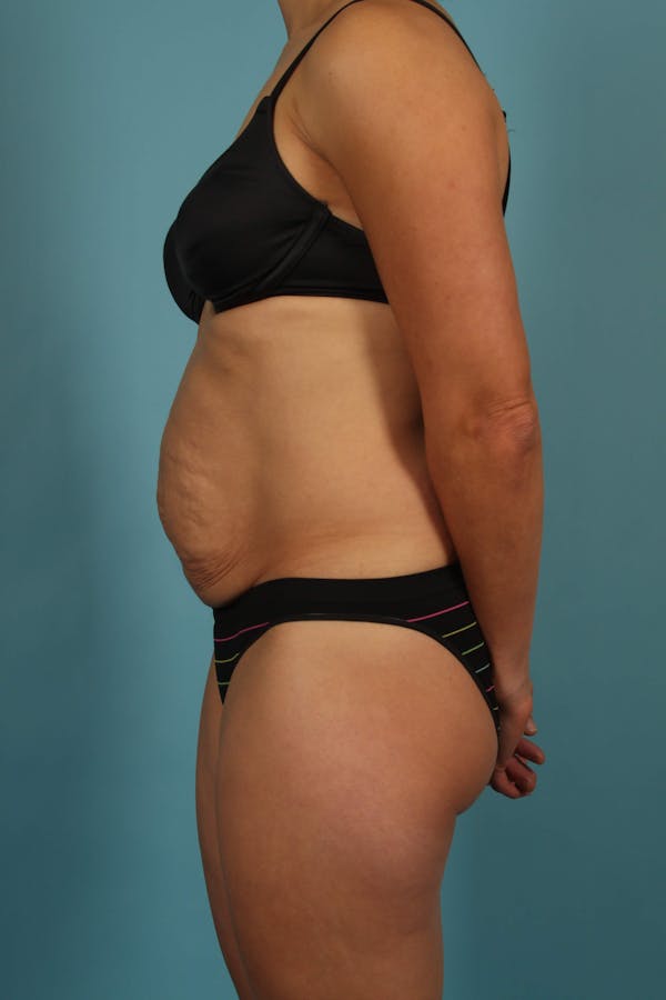 Tummy Tuck (Abdominoplasty) Before & After Gallery - Patient 13574688 - Image 5