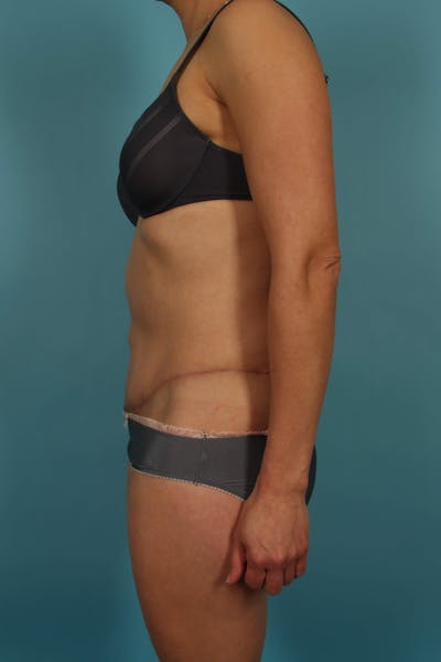 Tummy Tuck (Abdominoplasty) Before & After Gallery - Patient 13574688 - Image 6