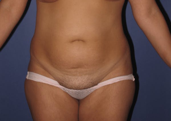 Tummy Tuck (Abdominoplasty) Gallery - Patient 13574689 - Image 1
