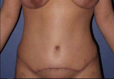 Tummy Tuck (Abdominoplasty) Gallery - Patient 13574689 - Image 2