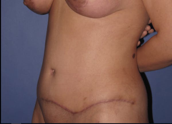Tummy Tuck (Abdominoplasty) Before & After Gallery - Patient 13574689 - Image 4
