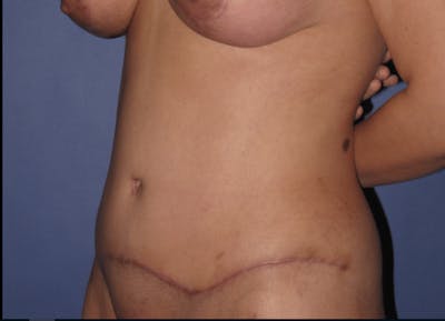Tummy Tuck (Abdominoplasty) Gallery - Patient 13574689 - Image 4