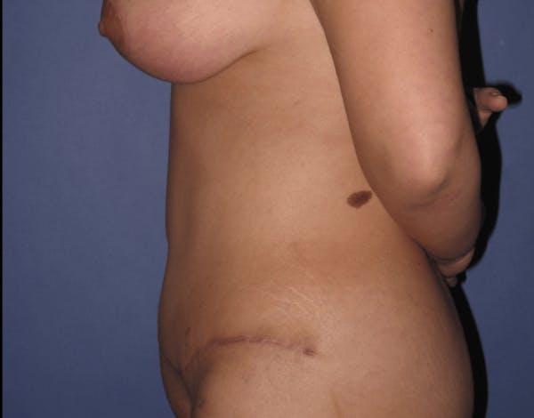 Tummy Tuck (Abdominoplasty) Before & After Gallery - Patient 13574689 - Image 6