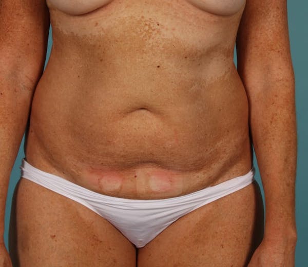 Tummy Tuck (Abdominoplasty) Before & After Gallery - Patient 13574691 - Image 1