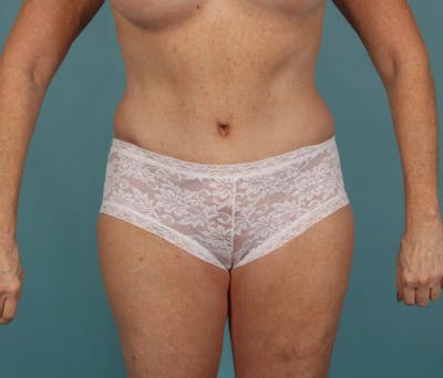 Tummy Tuck (Abdominoplasty) Before & After Gallery - Patient 13574691 - Image 2