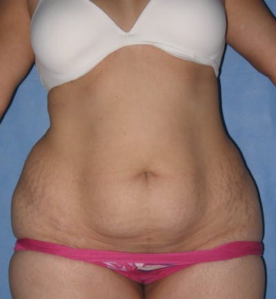 Tummy Tuck (Abdominoplasty) Before & After Gallery - Patient 13574694 - Image 1