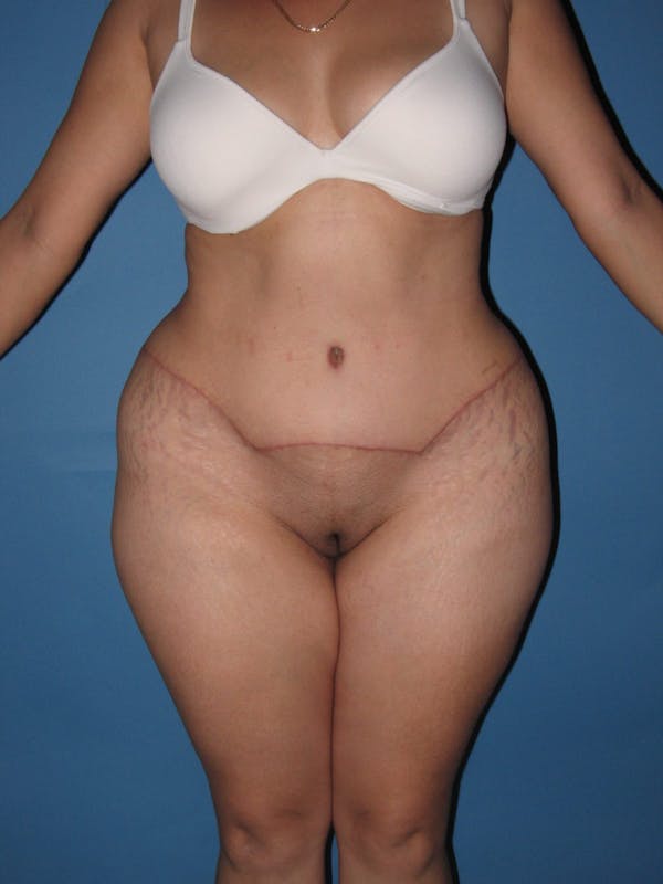Tummy Tuck (Abdominoplasty) Gallery - Patient 13574694 - Image 2